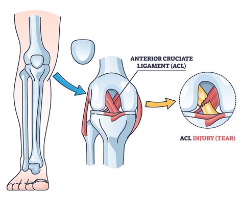 predisposition to acl tears